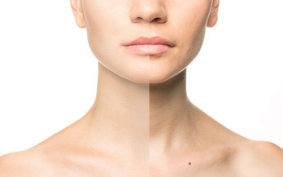 FACE, NECK AND DÉCOLLETAGE LIFT – USING ULTHERAPY® (HIFU)