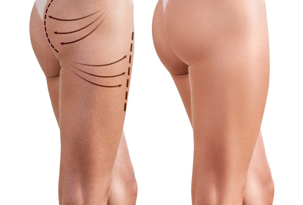 How can I get a buttlift?